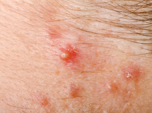 Pustulöse Pusteln mit weißen Köpfen auf der Haut: Staphylococcus aureus Staphylococcus
