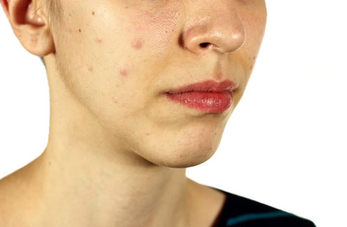 Blackheads, clogged pores, black spots: how to deal with T-zone problems black spots, clogged pores