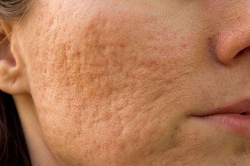 After inflammation on the skin there are traces of postacne: how to get rid of them postacne