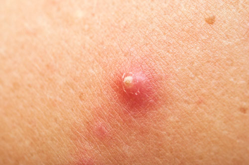 Pickel mit weißen Köpfen. Könnte es Staphylococcus aureus sein? weißköpfige Pickel