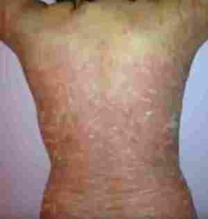 Die Krankheit Psoriasis - Diagnose oder Urteil