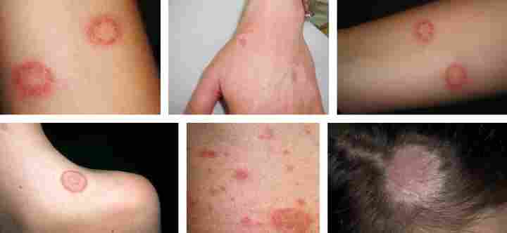Herpes zoster nelle prime fasi di sviluppo