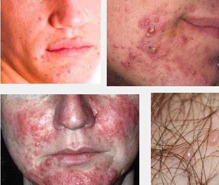 Adult male acne on the face: causes, treatment and prevention An adult male has acne on his face